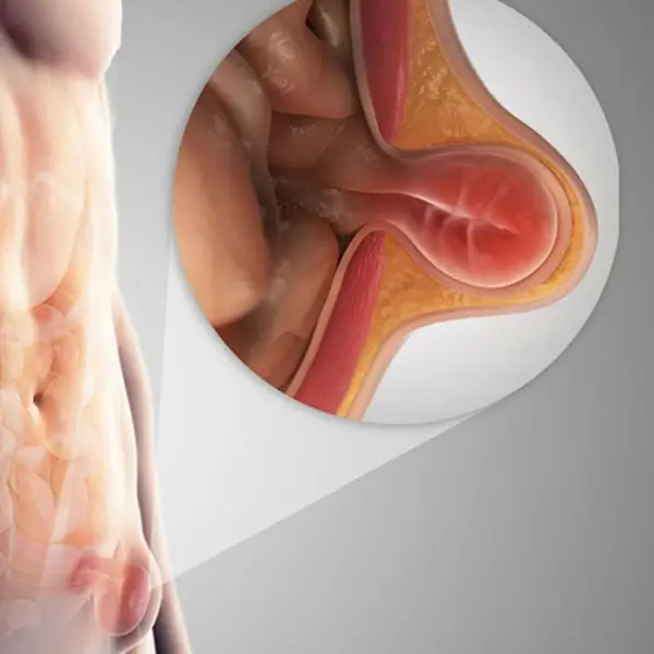 Kasık Fıtığı Tedavisi Kasık Fıtığı Tedavisi